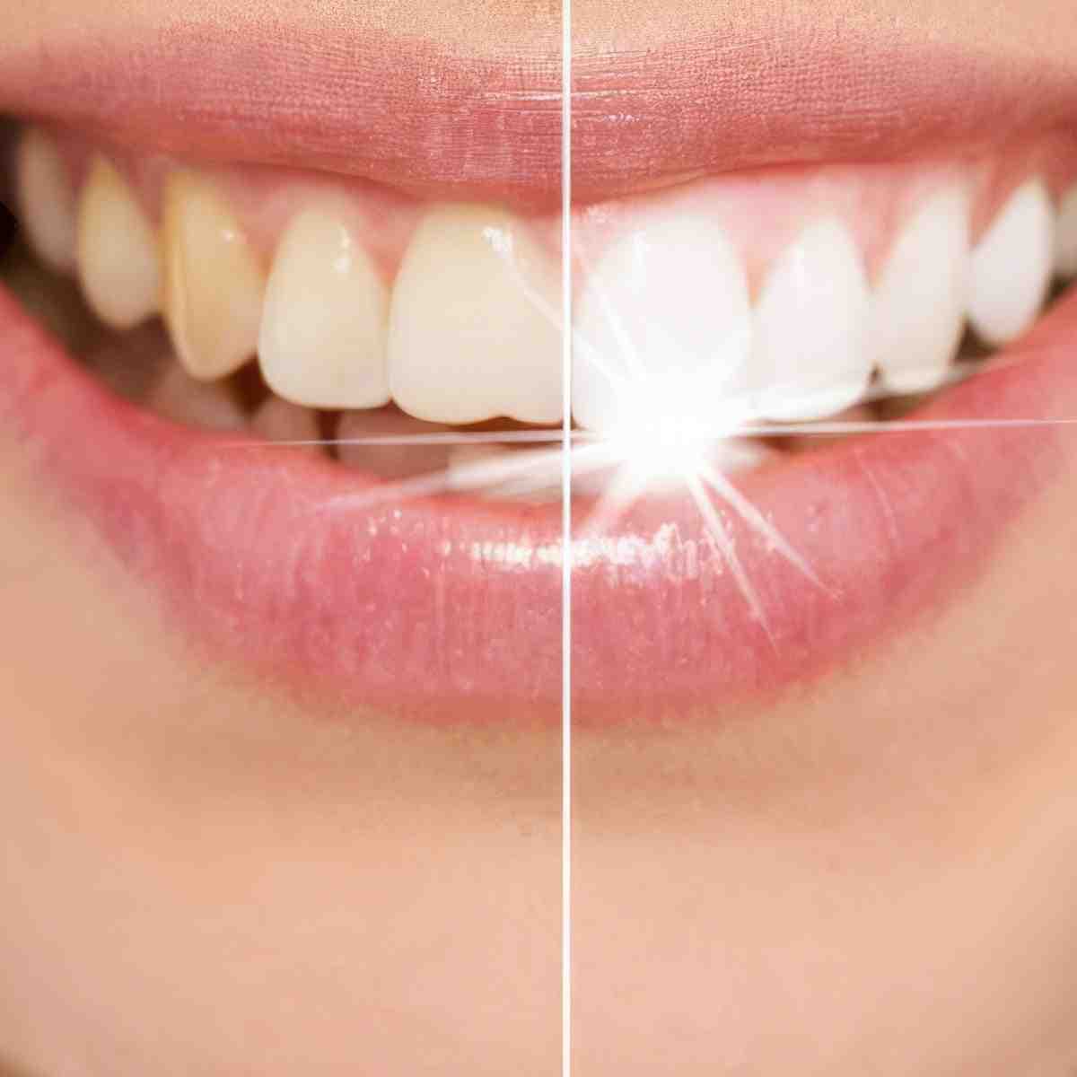 Kosmetyczne wybielanie zębów | Rzeszów