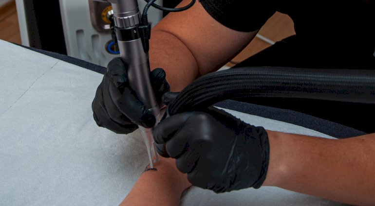 Usuwanie tatuażu w Clearink